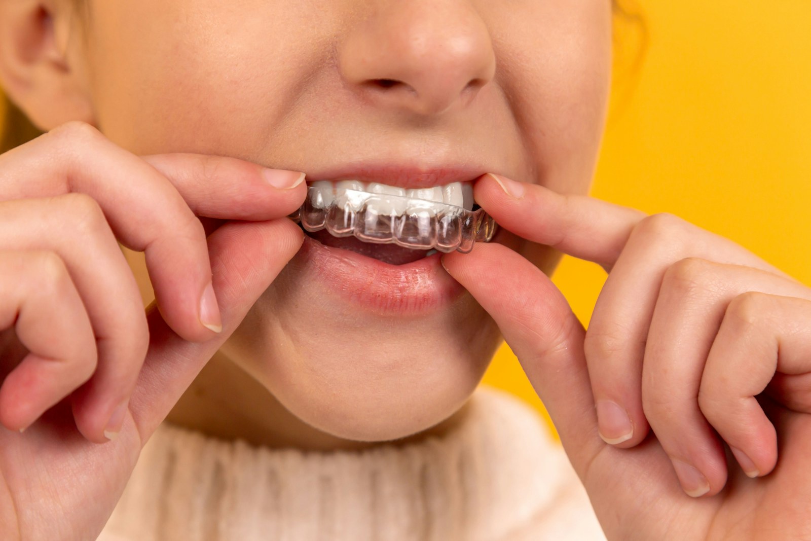 Clear orthodontic aligner being fitted